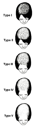 hair_loss_2